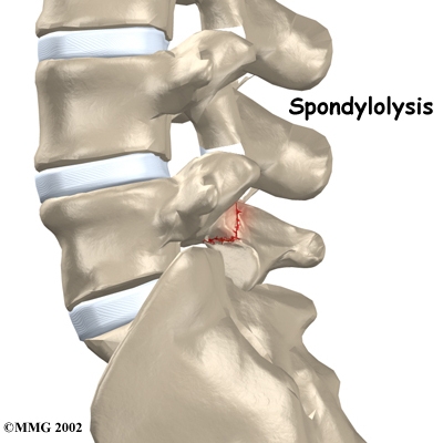 lumbar_spondylolysis_intro01.jpg