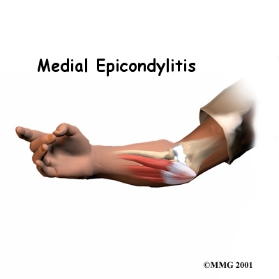 A Patient's Guide to Cubital Tunnel Syndrome - Hand and Upper Limb