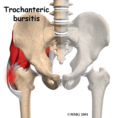 Trochanteric Bursitis and how Pilates & Rebounding helped me.