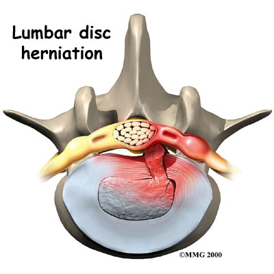 A Patient's Guide to Herniated Discs